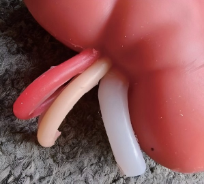 Kidney Lesion Model