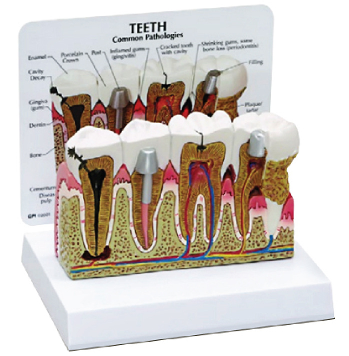 Teeth (Healthy / Pathologies) Model, 4x Enlarged