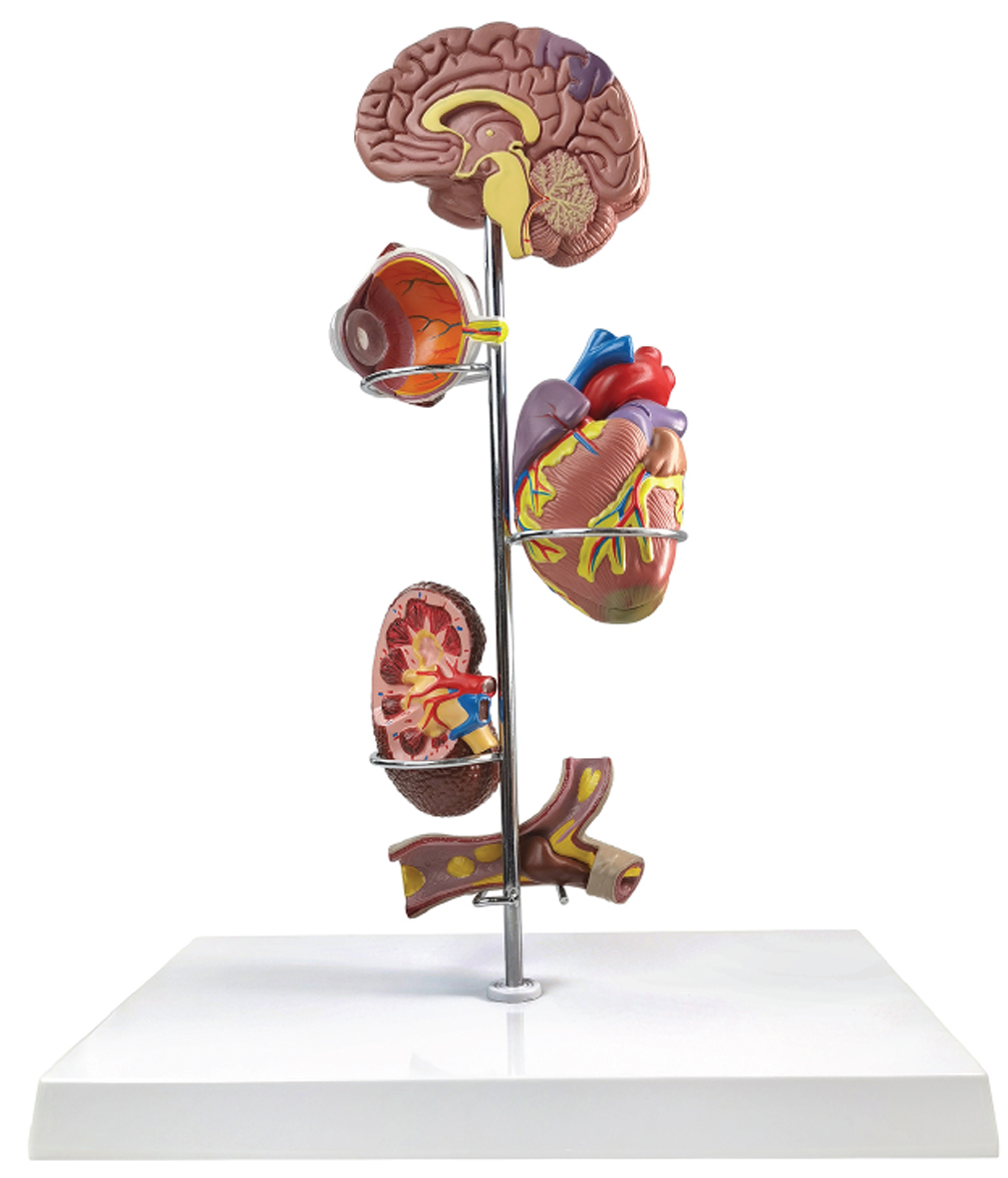 Effects of Hypertension, 5 Parts