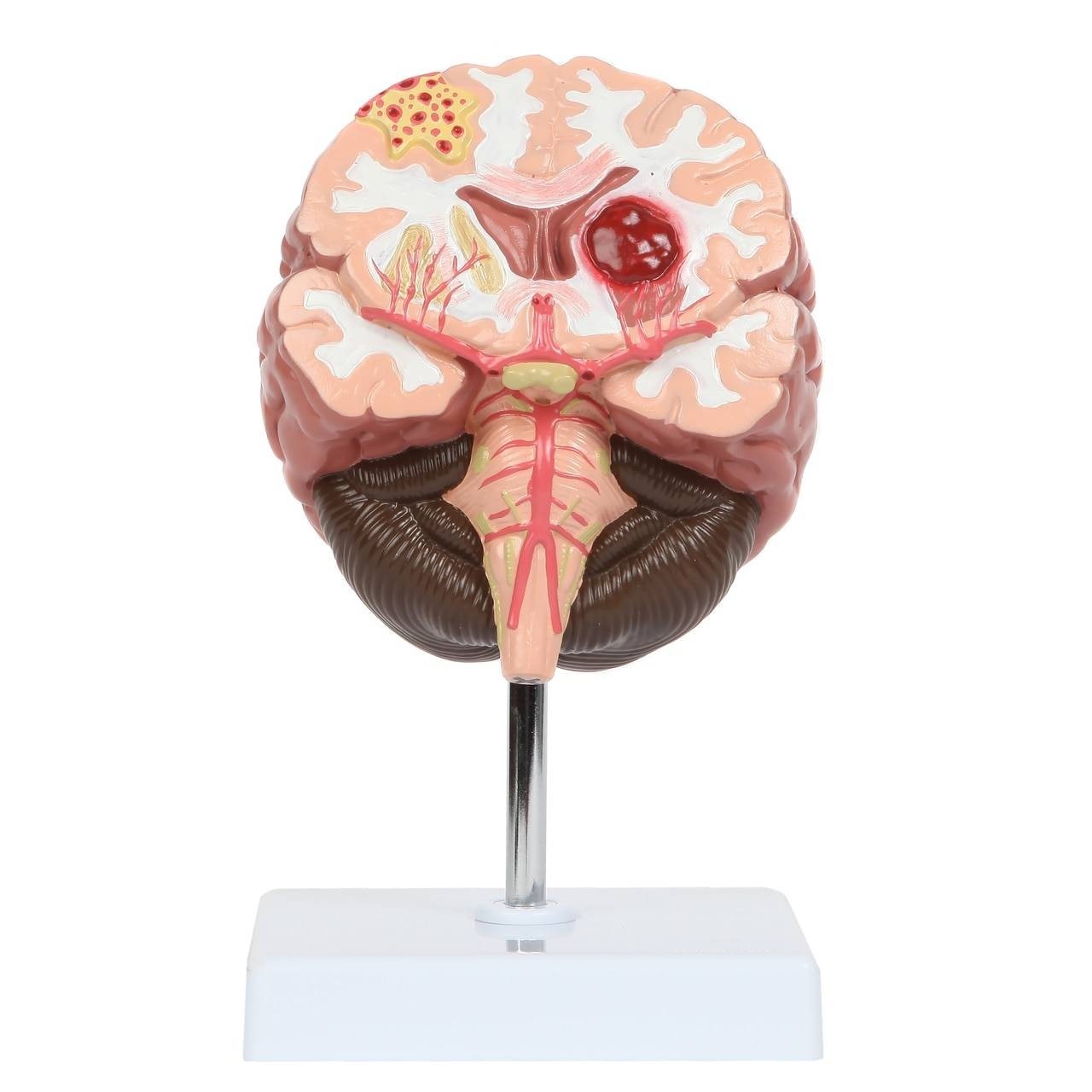 Brain Pathologies, Stroke, Life Size, 1 Part