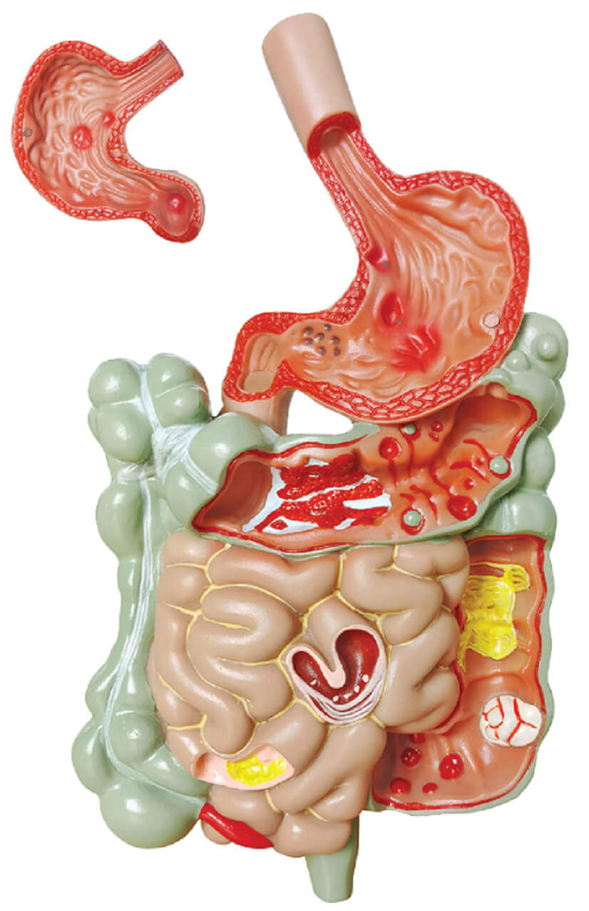 Pathological Model of the Digestive System, 1/4 Life Size, 2 Parts