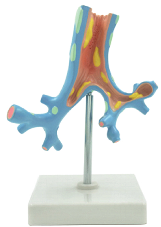 Pathological Model of the Bronchi, 1 Part