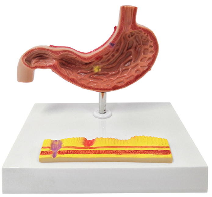 Gastric Pathology Model, 2 Part