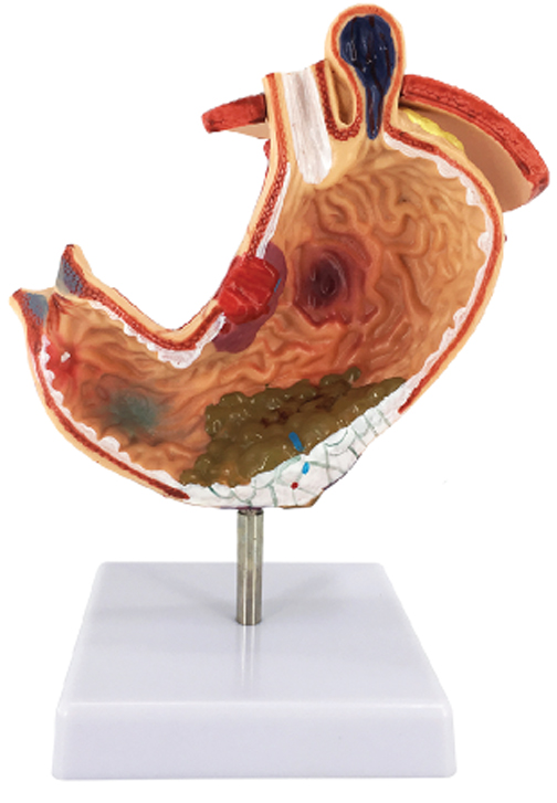 Gastric Pathology Model with Diaphragm, Life Size