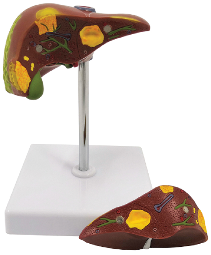 Pathological Model of the Liver, 2 Part