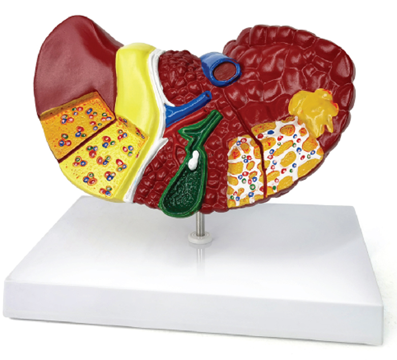 Pathological Model of the Liver