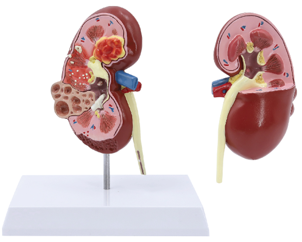 Two-sided Normal & Pathologies Kidney Model