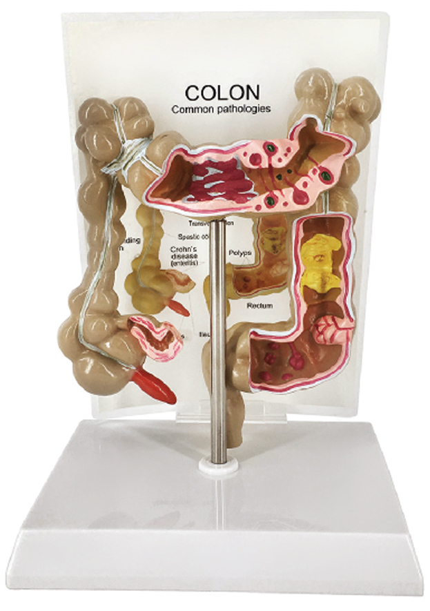 Pathological Model of Colon and Rectum, Half Size