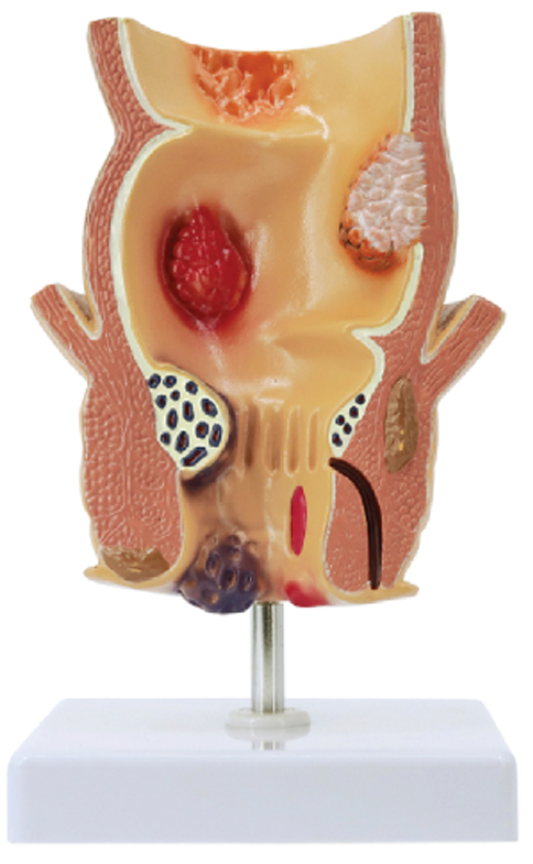 Pathological Model of the Rectum, 1 Part