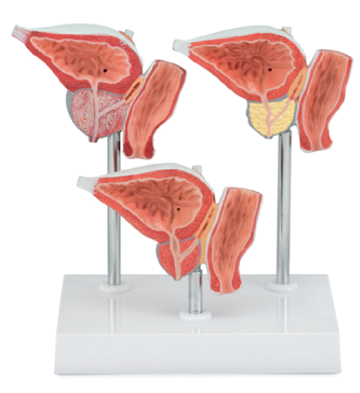 Normal and Diseased Prostate Gland, 3Parts