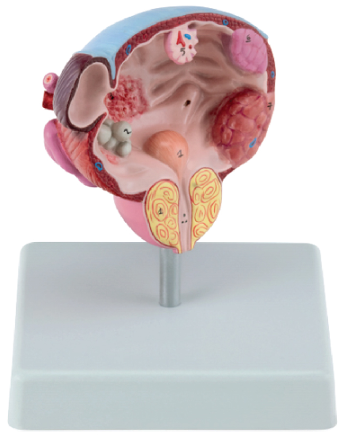 Pathological Model of Bladder and Prostate Gland