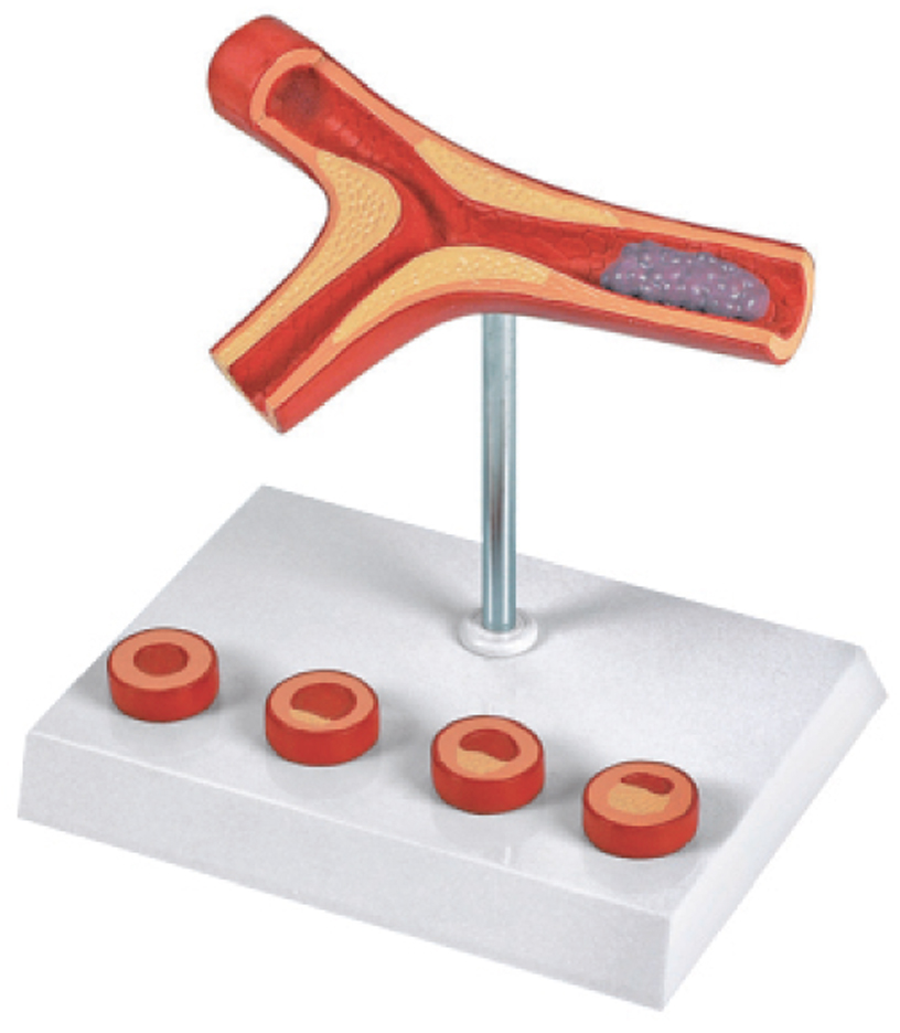 Atheriosclerosis and Thrombosis Model(10x Enlarged), 5 Parts