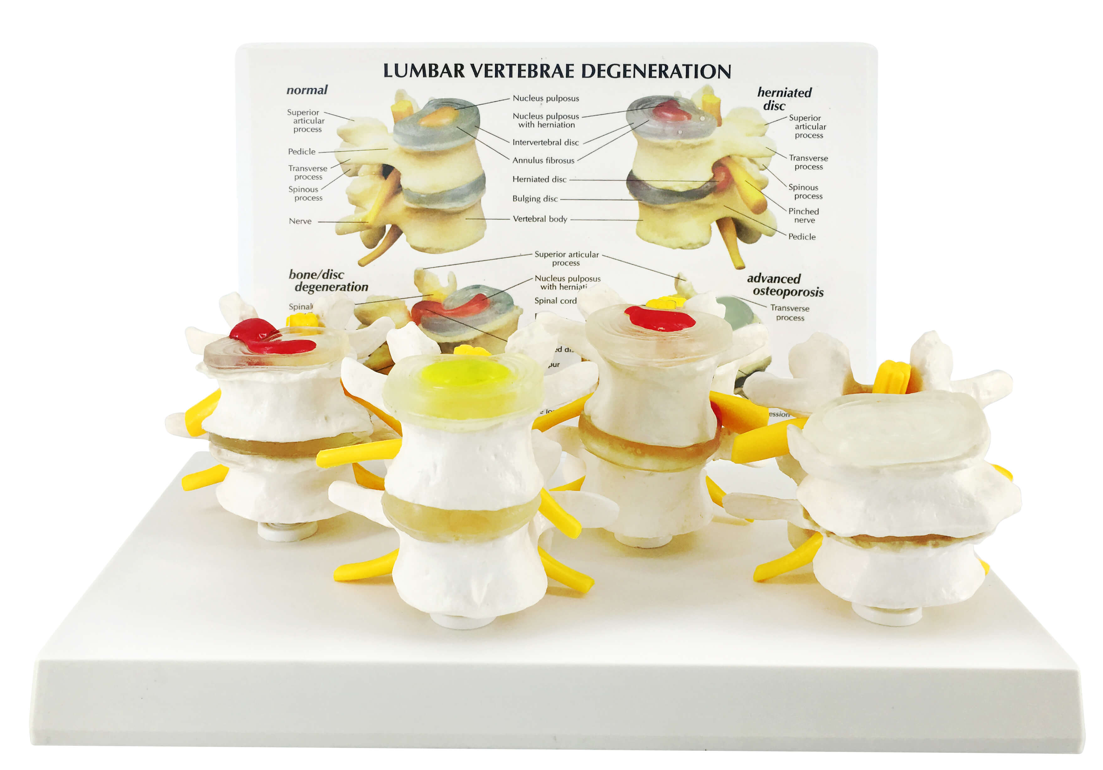 4-Stage Degenerative Lumbar Spine Model, 4 Parts