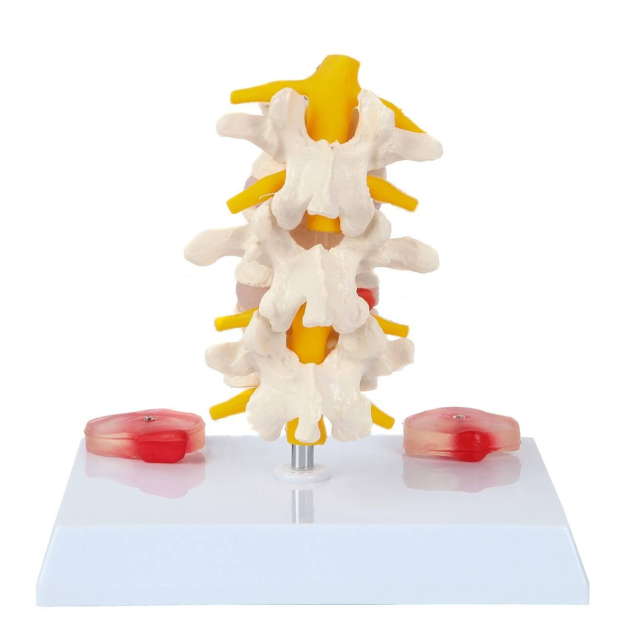 Two Lumbar Spine with Diseased Discs, Life Size
