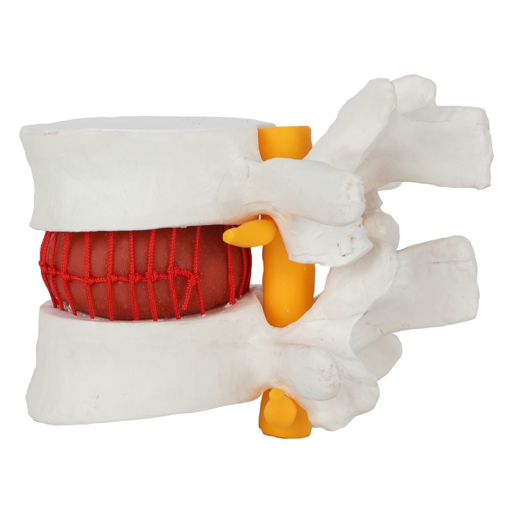 Herniated Intervertebral Disc Model